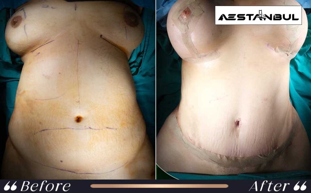 does fat come back after liposuction - Does Fat Come Back After Liposuction: What International Patients Should Know