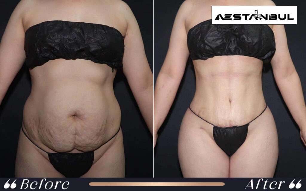 does fat come back after liposuction - Does Fat Come Back After Liposuction: What International Patients Should Know